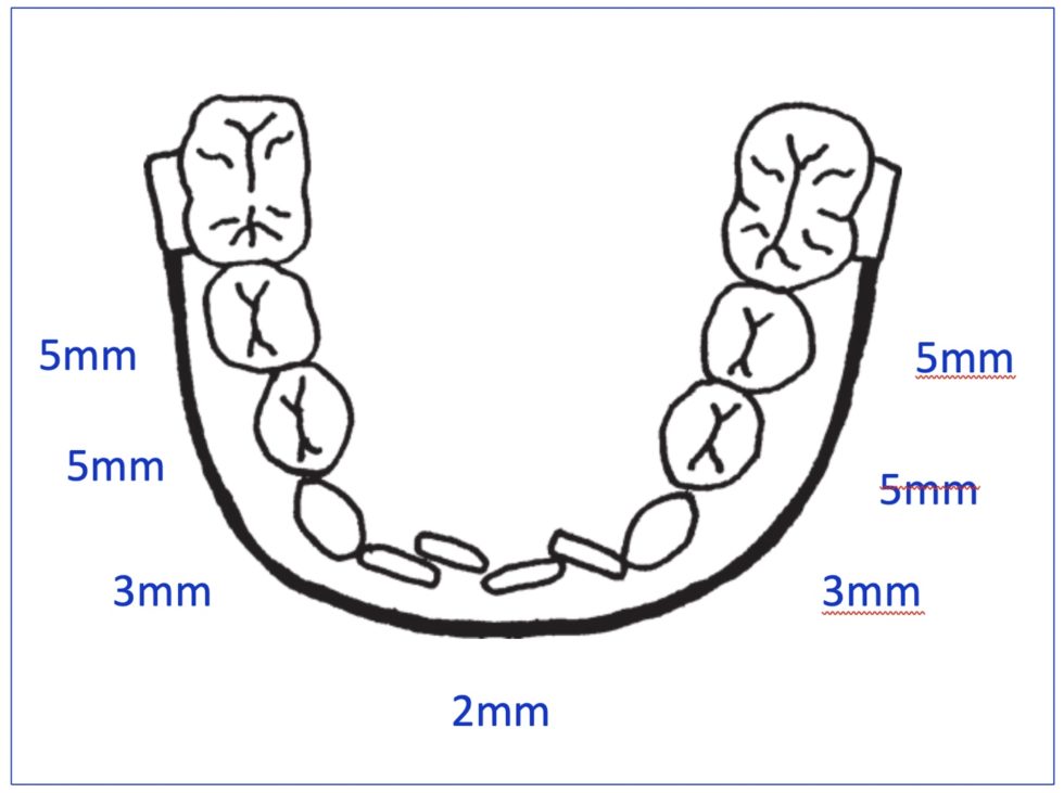 Orthodontic Demonstration Lip Bumper [Video] Williams GP