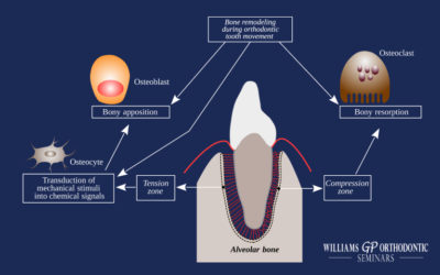 The Role of Inflammation in Orthodontic Tooth Movement