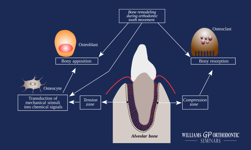The Role of Inflammation in Orthodontic Tooth Movement